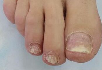 Mycosis on the nails causes problems