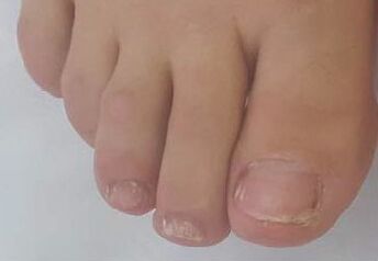 Promicil cures advanced onychomycosis