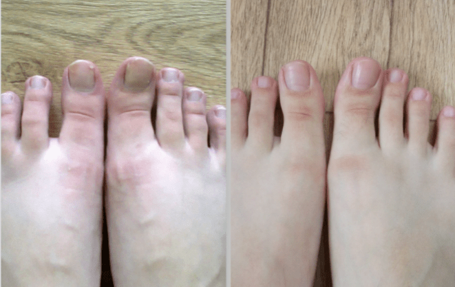 before and after treatment for toenail fungus