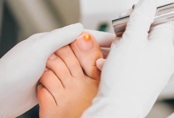 laser treatment for toenail fungus