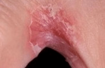 Fungus on the feet between the fingers