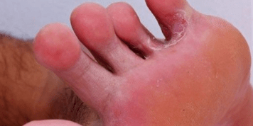 Fungus on the feet