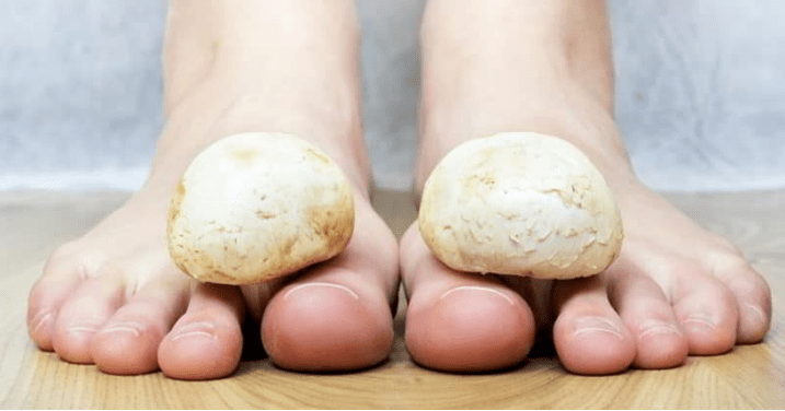 Fast fungal treatment at the feet at home