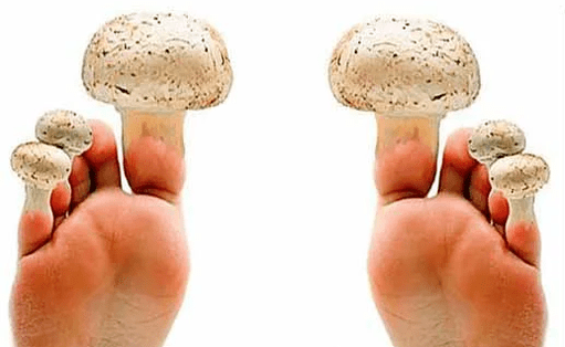fungus on nails