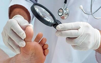 How to get rid of your nails fungus