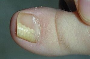 Reason -as a fungal appearance in the toes