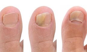Stage of fungal development in the toes