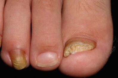 Micosis of the nails in the feet