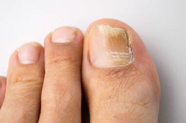 Mycosis caused by yeast microorganisms