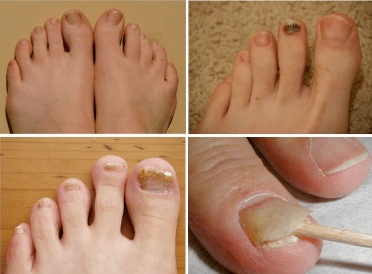 Sign of nail fungus