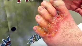 Symptoms of fungus on the toes