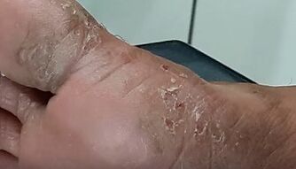 the type and shape of a fungus on the toes