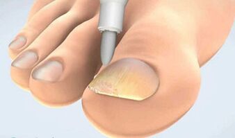 Onychomycosis scraping collection