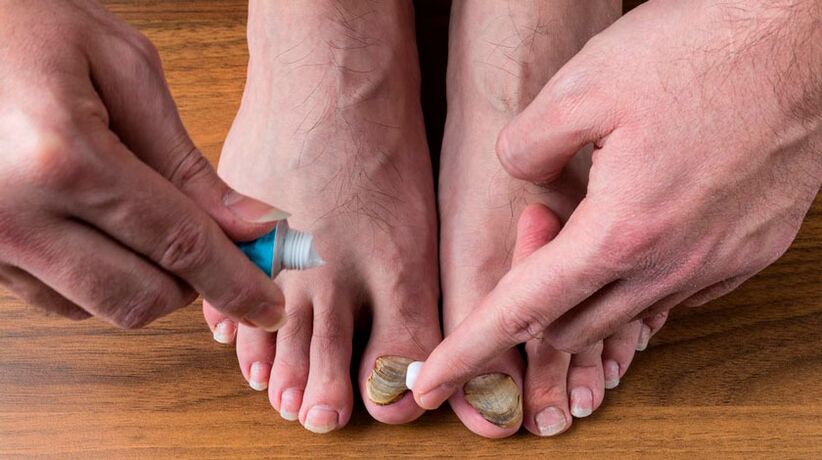 Apply an antifungal cream to the toenail to treat onychomycosis